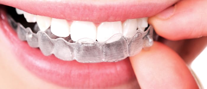 Adjusting to Invisalign® takes time