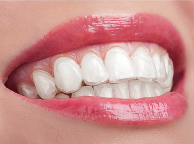 Invisalign dental braces