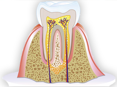 root canal treatment