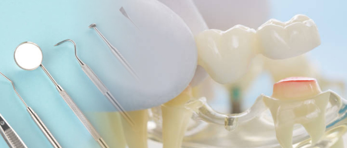How to Properly Take Care of Your Dental Bridge | Teeth First Dental Blog