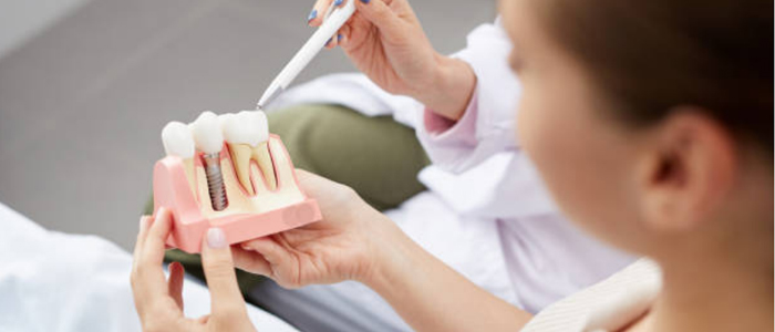 Dental Implant FAQ