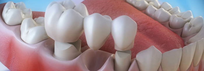 Dental Bridge close up