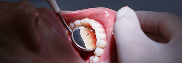 Wisdom Tooth Extraction