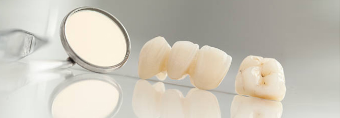 5 Questions about tooth crowns