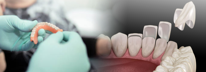 Difference between veneers and dentures