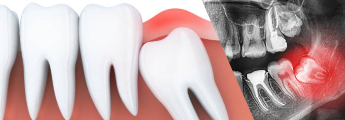 Wisdom Tooth Extraction