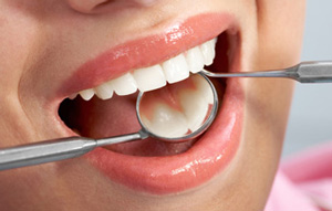 dental fillings