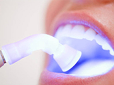 Free teeth whitening