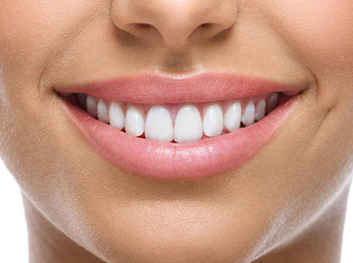 dental veneers